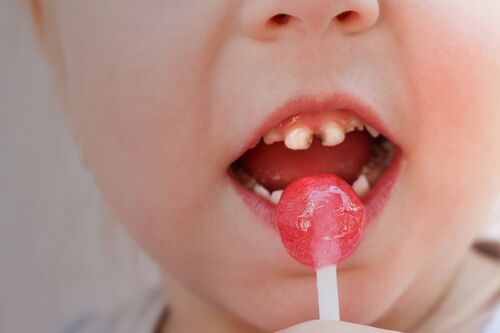 Early Childhood Caries